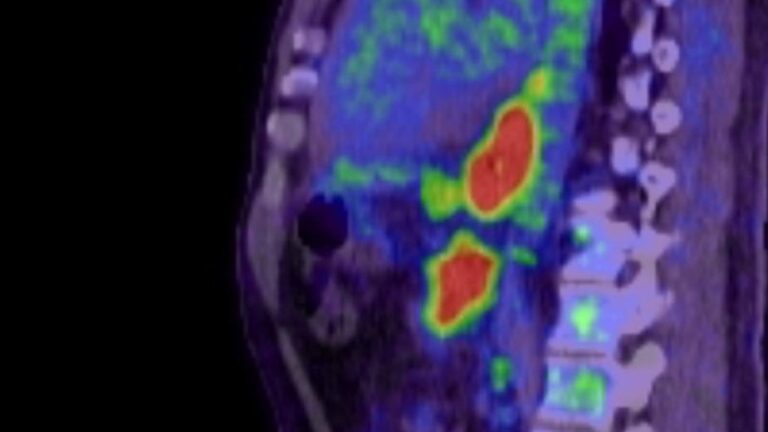 Part 3: The Warburg Effect Explained - What This Means in Real Life - Imaging, Diet, and Therapy cover
