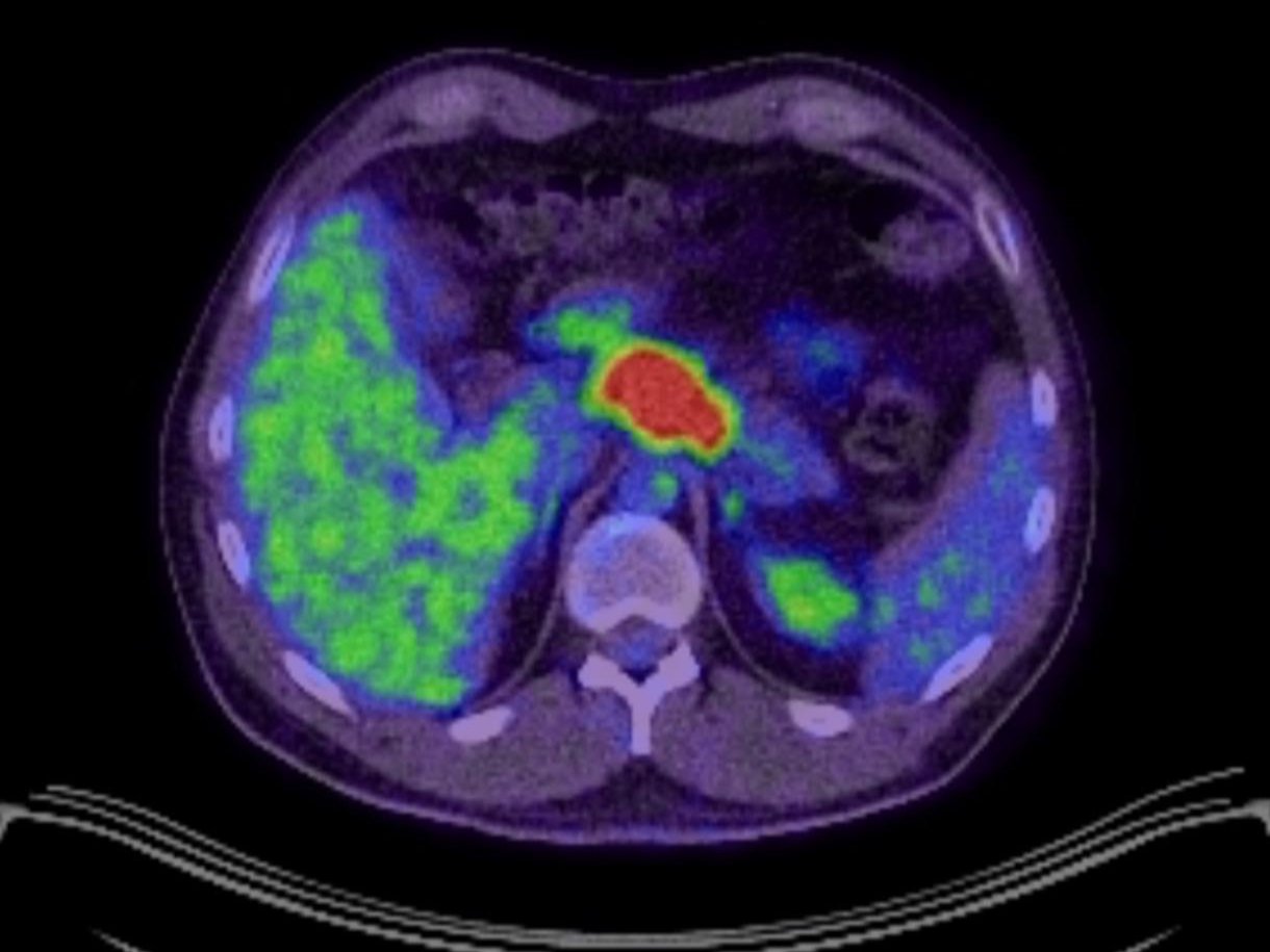 Warburg Effect Cancer